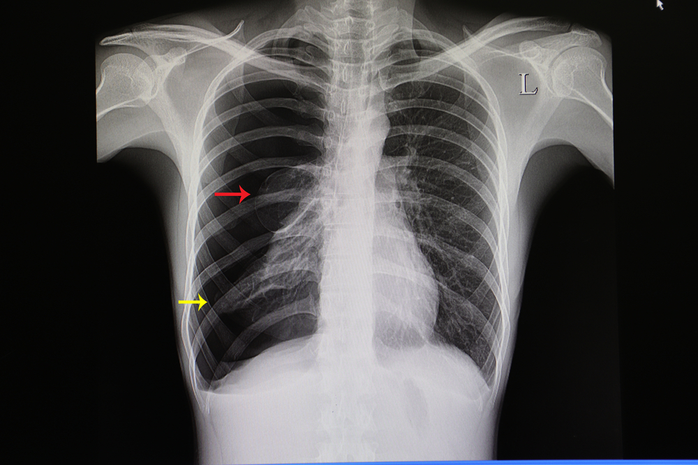 A,Chest,Xray,Film,Of,A,Patient,With,Large,Pneumothorax