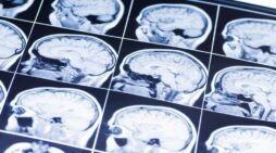 Understanding the Three Most Common Types of Traumatic Brain Injuries