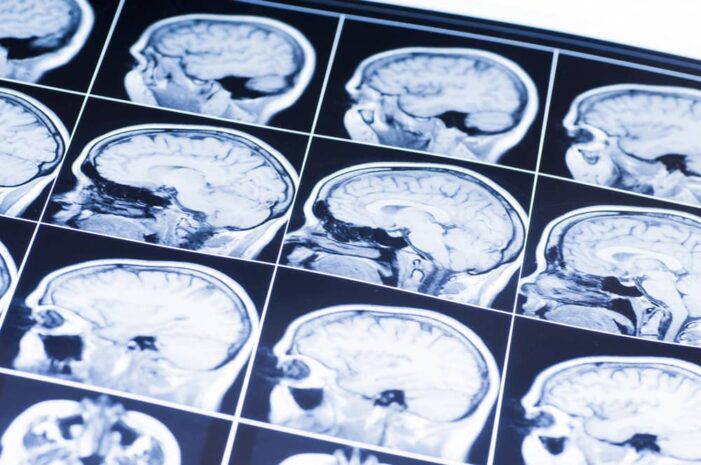 Understanding the Three Most Common Types of Traumatic Brain Injuries