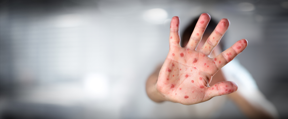 Viral,Diseases,-,Hand,Infected,-,Hand,Foot,And,Mouth